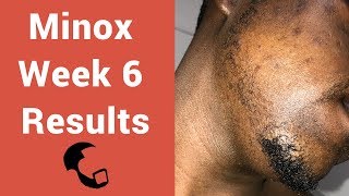 Growing a Beard With Minoxidil A Black Mans Experience Week 6 Vellus Invasion [upl. by Anyd]