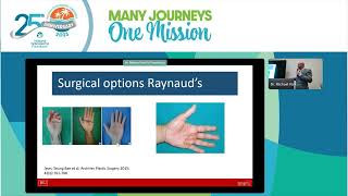 Raynauds Ulcerations and Calcinosis in Systemic Sclerosis Michael York MD [upl. by Eerolam]