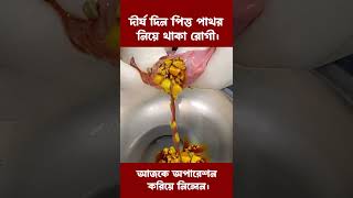 দীর্ঘ দিন পিত্ত পাথর নিয়ে থাকা রোগীআজকে অপারেশন করিয়ে নিলেন। gallstones পিত্তথলিরপাথর [upl. by Adleremse]