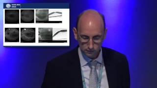 EuretinaESCRS 2016  Subthreshold Laser Therapy for Central Serous Chorioretinopathy [upl. by Ahsiekram]