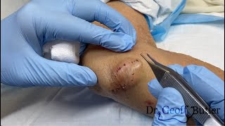 Removal of a fairly large epidermal cyst on the elbow [upl. by Masuh]