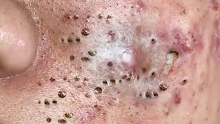 Blackhead Removal With Sac Dep Spa 1000443 [upl. by Talley]