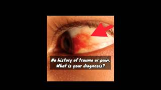 Subconjunctival Hemorrhage mbbs neetpg [upl. by Nivel494]