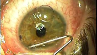 IntraLase Lasik Surgery  Right Eye [upl. by Vasya]