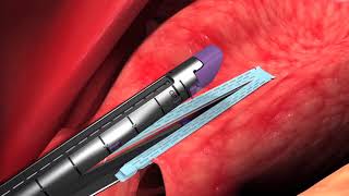 Animation Endo GIA™ Reinforced Reload with Tri Staple™ Technology Chapter 3 orSo6xtt1DI [upl. by Yddet]