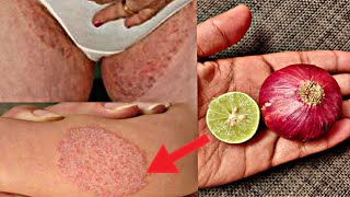 दाद खाज खुज्ली की 2 दिन में छुट्टी कर देगा fungal infection formula2019 daad khaj ka ilaj [upl. by Earl]