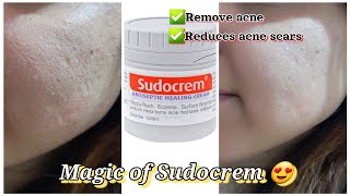 Sudocrem for acne  How to use sudocrem amp its benefits  One skincare solution [upl. by Eiral]