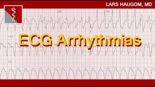 ECG Arrhythmias [upl. by Vaenfila]