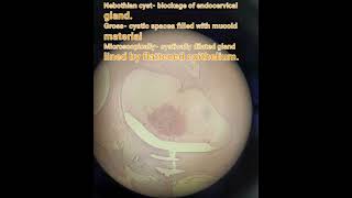 Nabothian cyst cervix pathology gynae non neoplastic  glandular lesion medical [upl. by Ais]