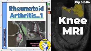 Fig 5E04 Rheumatoid Arthritis  Erosion and Synovitis [upl. by Roots432]