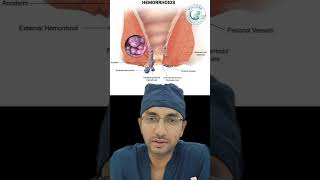 quot🔥 Decode Anal Pain Hemorrhoids Fissures amp Fistulas Explained 📊quot [upl. by Noteloc137]