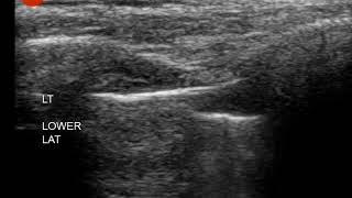 Pneumothorax  ultrasound  Lung Point [upl. by Yanal680]