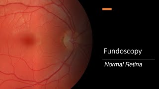 Healthy Retina Fundoscopy [upl. by Ydrah]