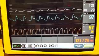 Basic Capnography [upl. by Aled]