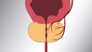 Prostatic Artery Embolization PAE Patient Video [upl. by High]