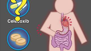 Cardiovascular Safety of Celecoxib  NEJM [upl. by Oniotna]