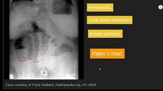 Rigler’s triad radiology abr core [upl. by Oag]