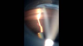 Gonioscopy video recorded using  Jaiz AIM [upl. by Renrag9]