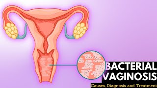 Bacterial vaginosis Causes Signs and Symptoms DIagnosis and Treatment [upl. by Uohk964]