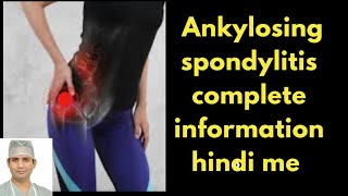 ankylosing spondylitis की सारी जानकारी हिन्दी में  आपके सभी सवालों के जवाब [upl. by Aholla]