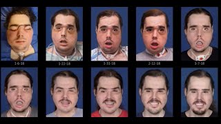 See the remarkable recovery progression of face transplant patient Cameron Underwood of Yuba City [upl. by Yllek]