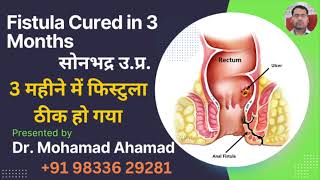 Fistula in ano Cured in 3 months I Dr Mohamad Ahamad  Call Now At 9833629281 [upl. by Dibri]