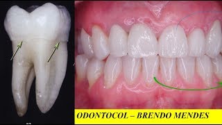 ANATOMIA DENTAL FACES DOS DENTES E COROA CLÍNICA E ANATÔMICA [upl. by Epoillac97]