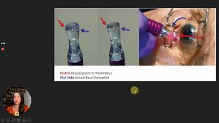 Glaucoma Day  quotLaser Micropulsadoquot [upl. by Tai]