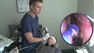 Balloon Sinuplasty Procedure  in office under local anesthesia [upl. by Kellen]