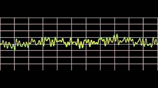 Sinusitis  Rife Frequencies [upl. by Dahlstrom117]