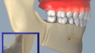 Sagittal Split Osteotomy [upl. by Aceissej877]