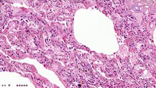 ARDS  Acute Respiratory Distress Syndrome  Histopathology [upl. by Llerraj328]