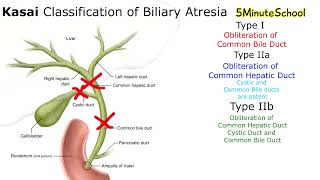 Kasai Classification of BIliary Atresia [upl. by Shama]