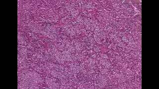 Histopathology PituitaryAcidophilic adenoma [upl. by Ahsikad537]