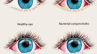 What is conjunctivitisTreatment of conjunctivitisآشوب چشم کیا ہے؟ اسکا آسان اور سستا علاج [upl. by Terhune369]