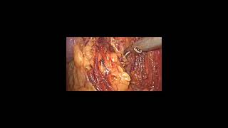 Laparoscopic Nephrectomy by Dr Negi [upl. by Lippold710]