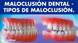 Maloclusión  ¿Cómo es la forma de correcta de la mordida  Tipos de maloclusiones dentales © [upl. by Calondra]