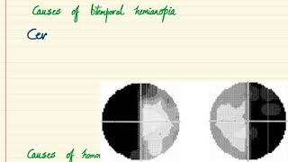 Ocular signs  Bitemporal Hemianopia and Homonymous Hemianopia [upl. by Tonya]