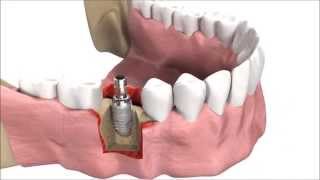 How DENTAL IMPLANTS are inserted  3D simulation [upl. by Madora]