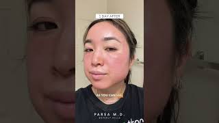 Cosmelan Peel Application and Results  Sun Spots Acne Scars and Hyperpigmentation [upl. by Tyler]