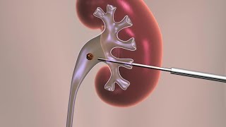 Percutaneous Nephrolithotomy [upl. by Earleen]