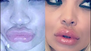 how I fixed my botched lip injections dissolver review [upl. by Brout]