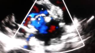 Echocardiogram  periprosthetic reflux leak in bioprosthetic mitral [upl. by Aratnahs462]