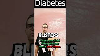 Blister on Foot Toe or Between Toes Diabetic Skin Symptoms [upl. by Korman]