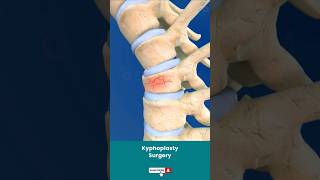 Spine Fracture Kyphoplasty ↪ 3D Medical Animation Shorts Kyphoplasty KyphoplastySurgery Spine [upl. by Kizzee]