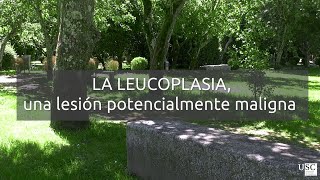 A leucoplasia oral [upl. by Adeys]