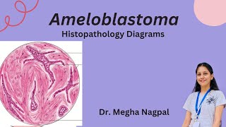 Ameloblastoma  Histopathology  Easiest Diagrams  Oral Pathology BDS [upl. by Adamik]