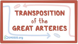 Double discordance congenitally corrected transposition of the great arteries Overview [upl. by Puttergill]