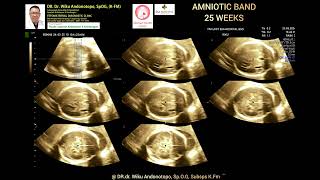 Amniotic Band syndrome 25 weeks [upl. by Ellehcyar]