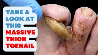 TAKE A LOOK AT THIS TOENAIL MASSIVE THICK TOENAIL [upl. by Trace]